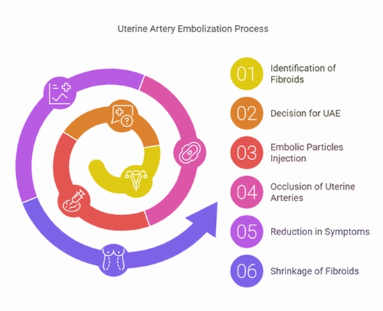 Uterine artery embolization for treatment of symptomatic fibroids {faces}